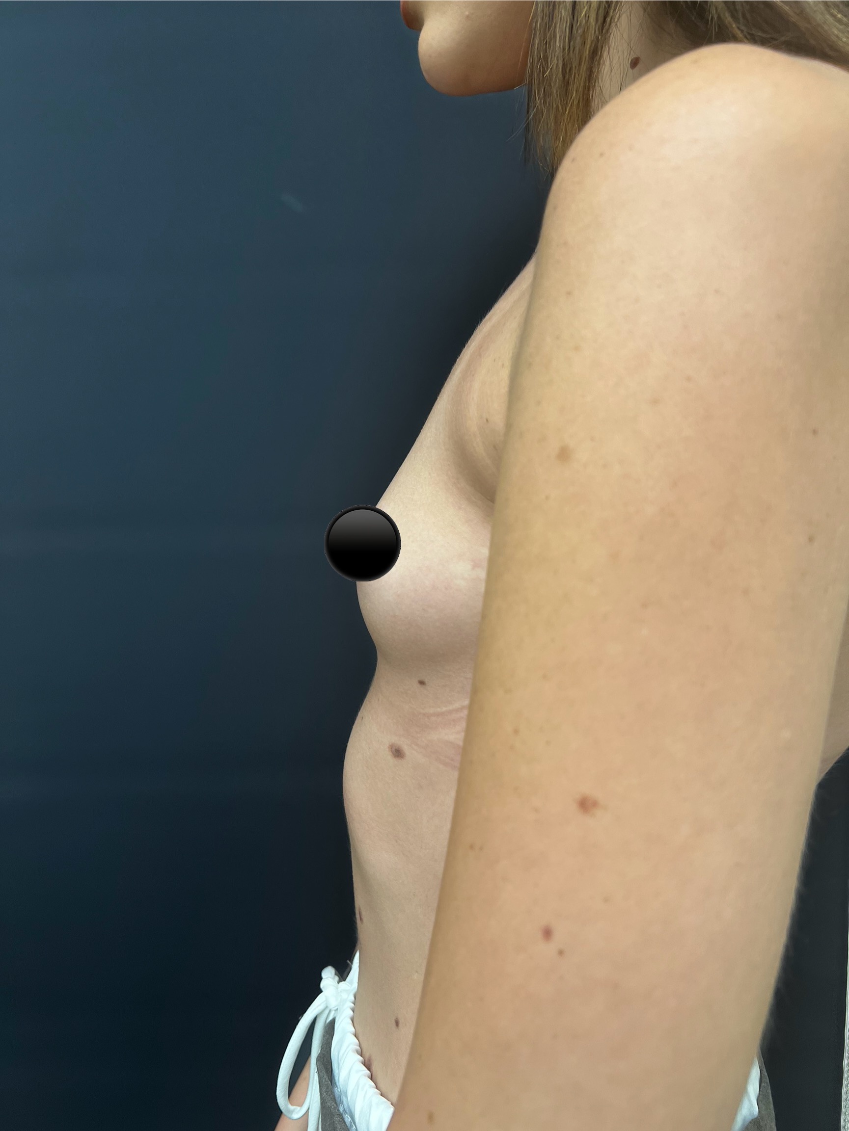 breast-augmentation-3