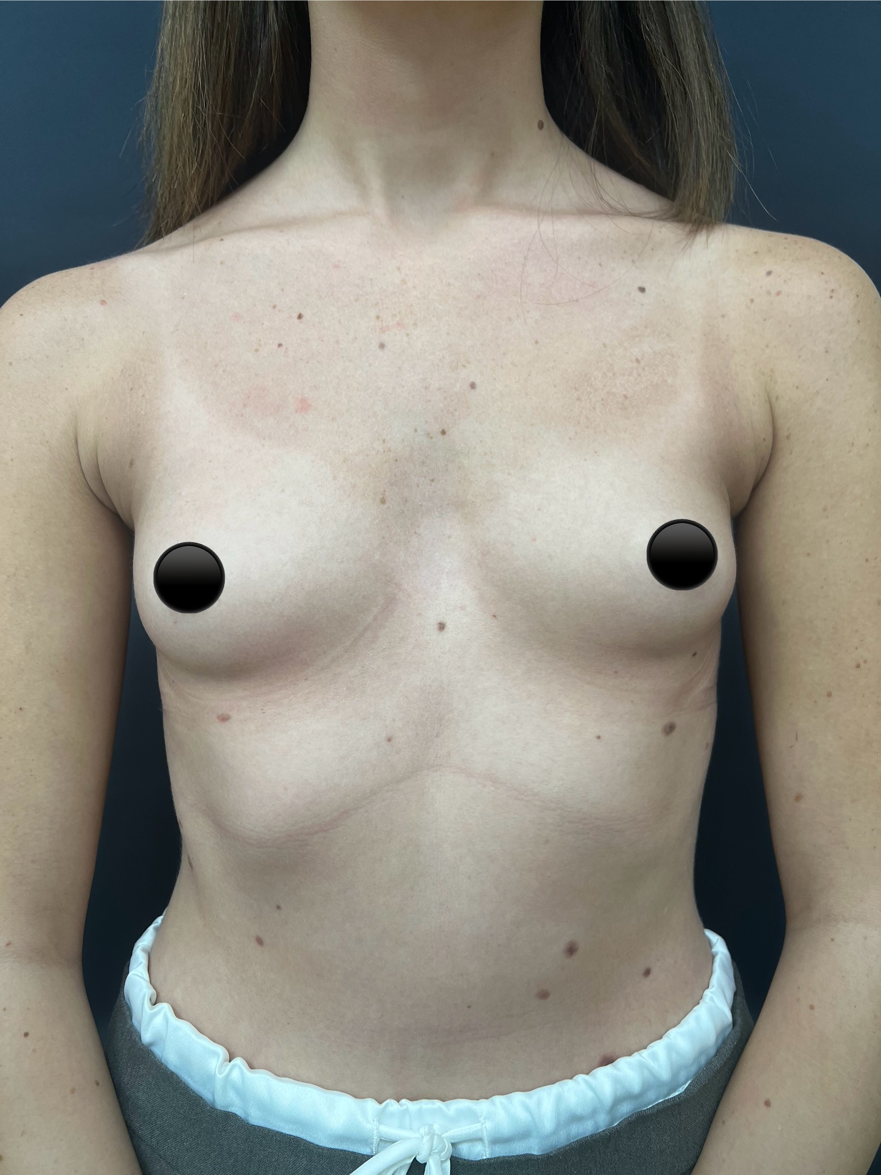 breast-augmentation-3