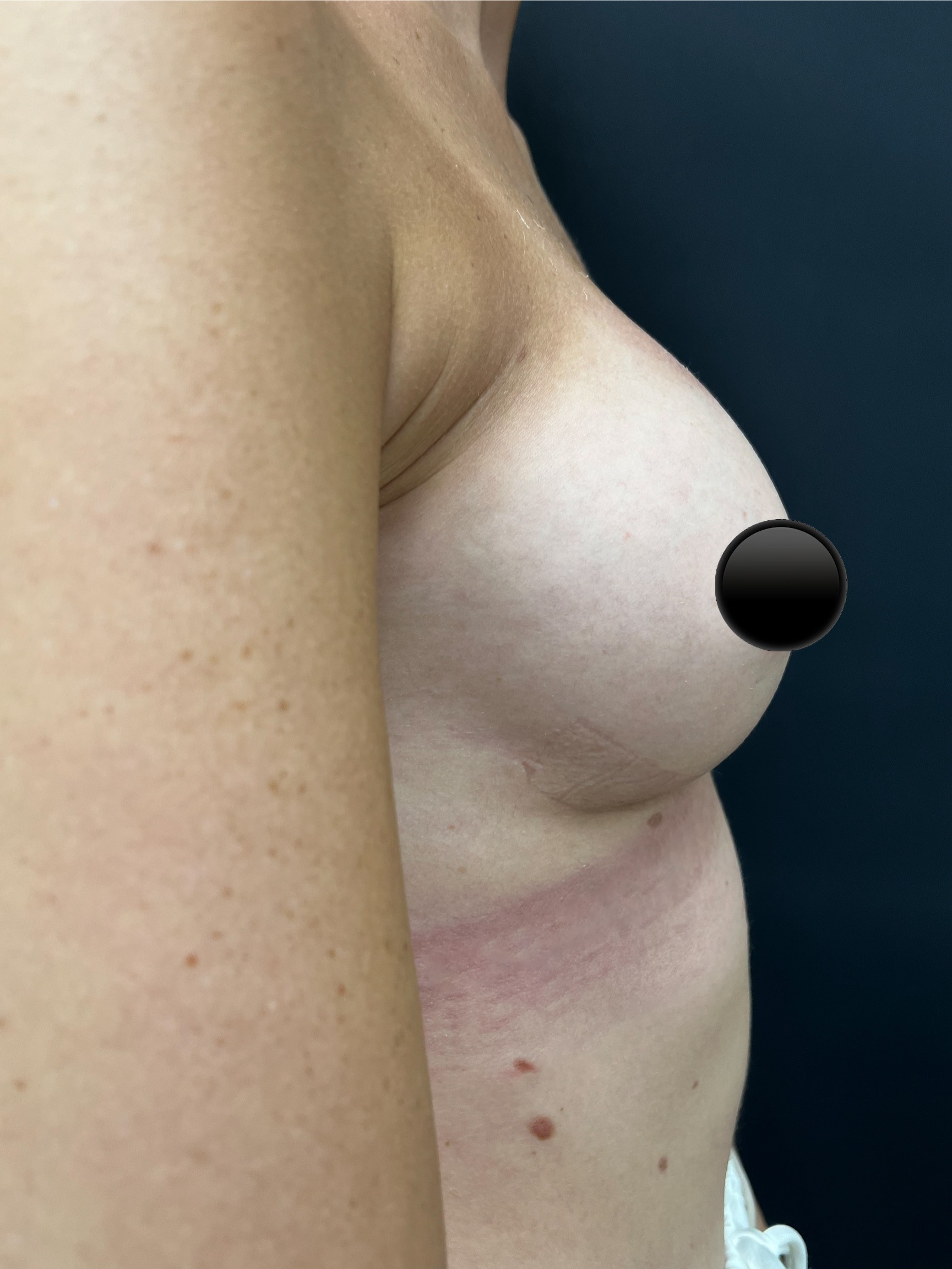 breast-augmentation-3