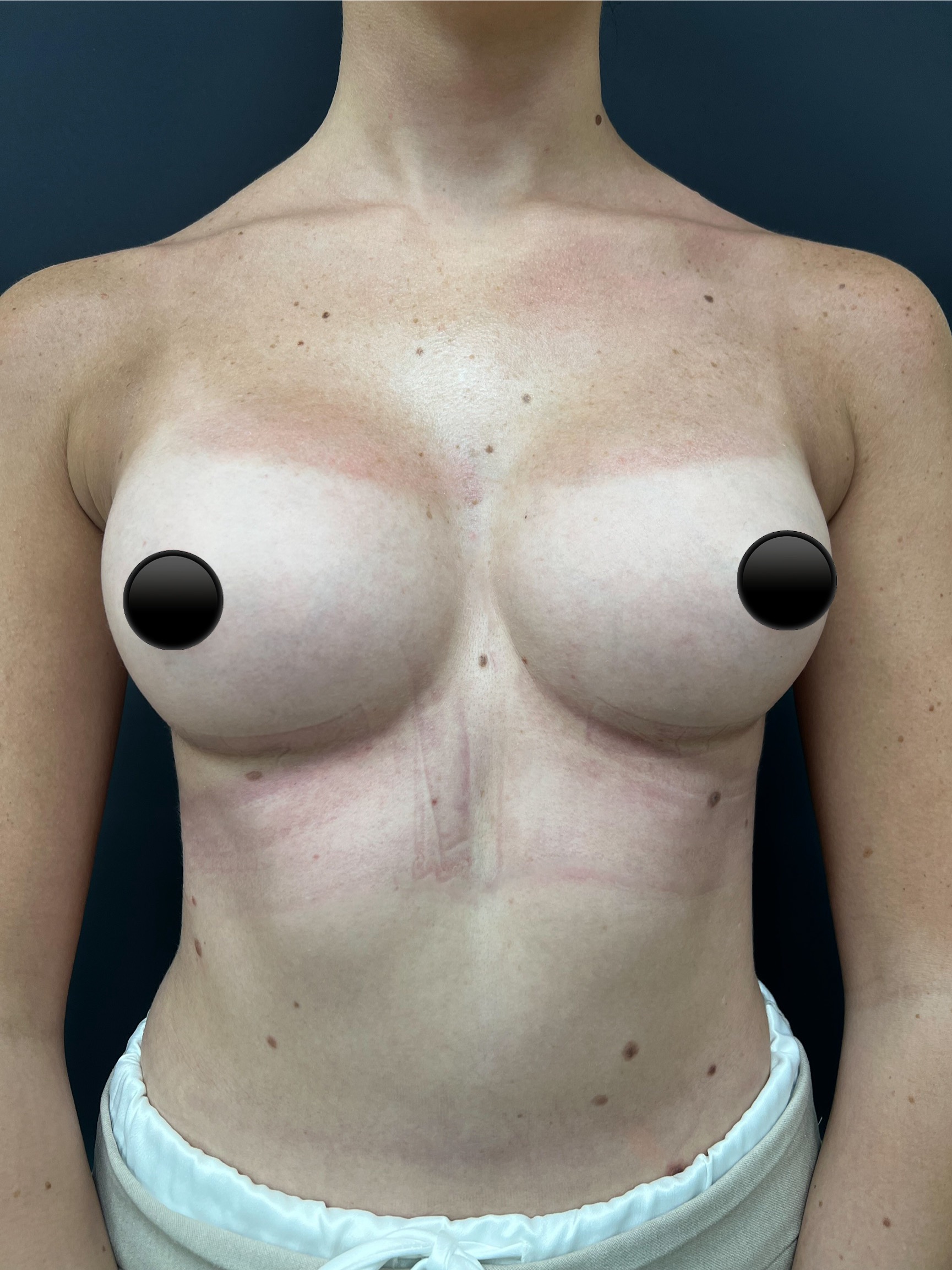 breast-augmentation-3
