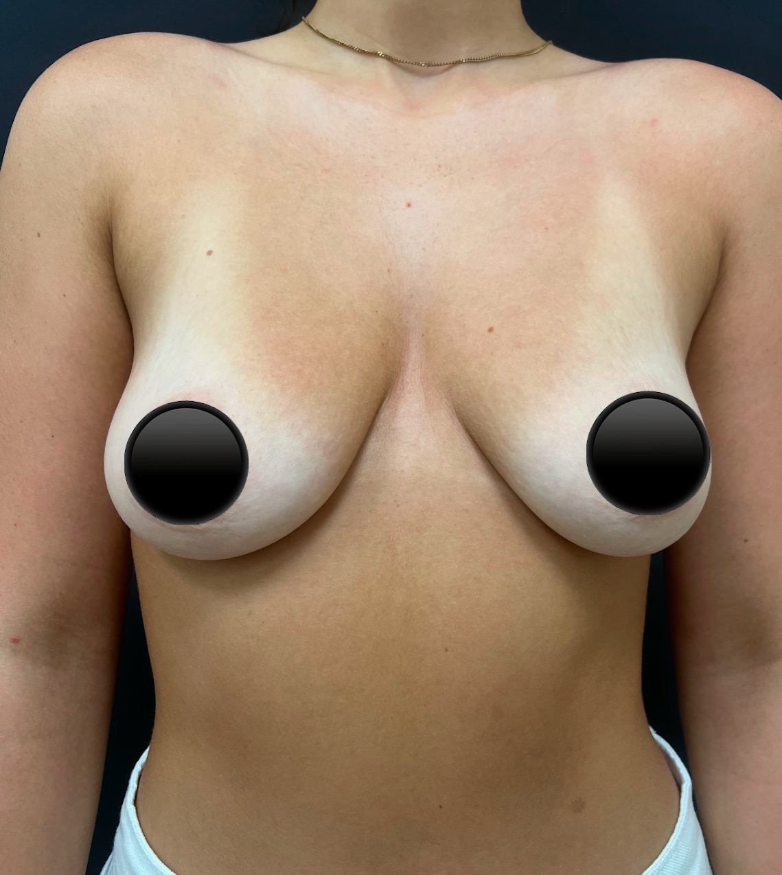 breast-augmentation-4