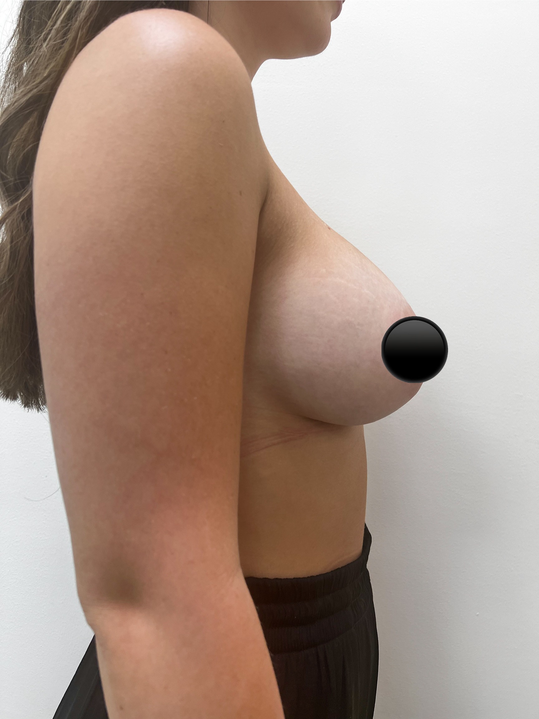 breast-augmentation-4