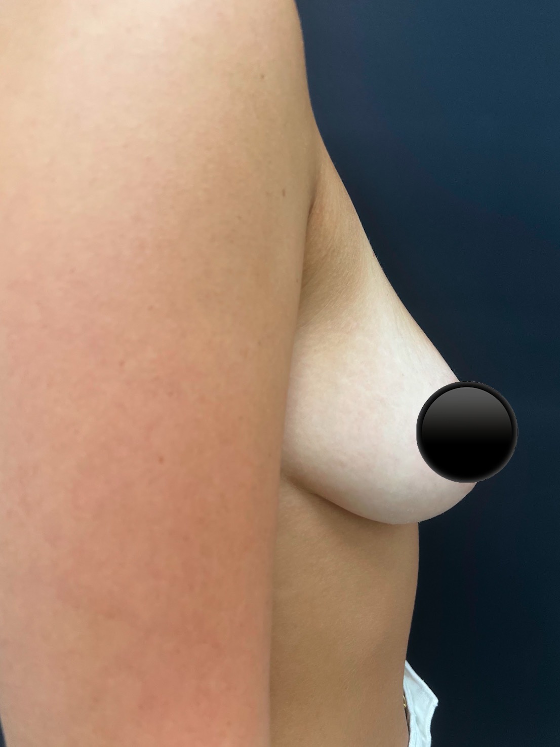 Dr. Charles Bain Breast Augmentation Before & After